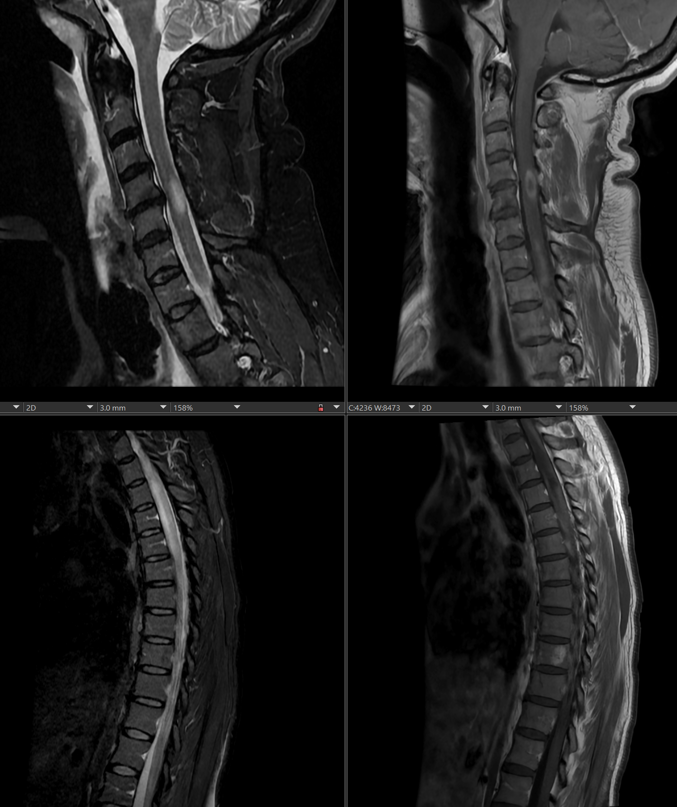 <p>Neuromyelitis Optica. MRI showing inflammation of the spinal column, a common aspect of neuromyelitis optica.</p>