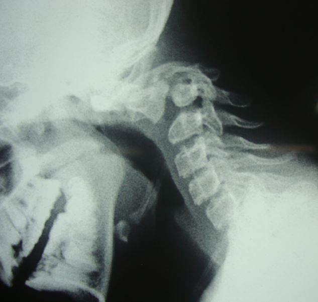 Swan neck deformity in neglected Hangman's fracture
