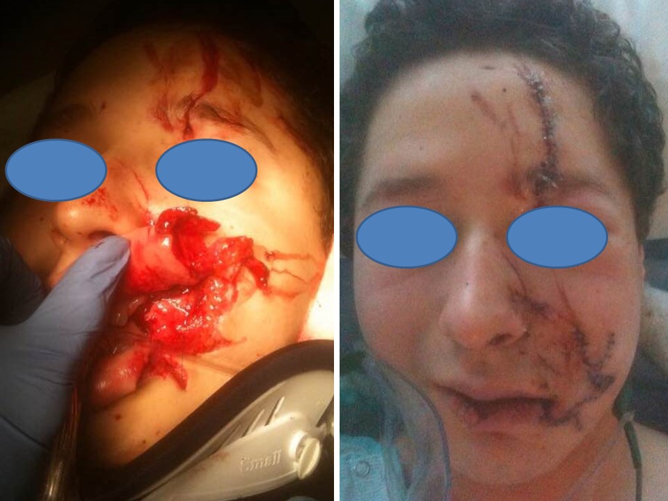 16-year-old male with a full-thickness stellate facial laceration due to a motor vehicle collision
