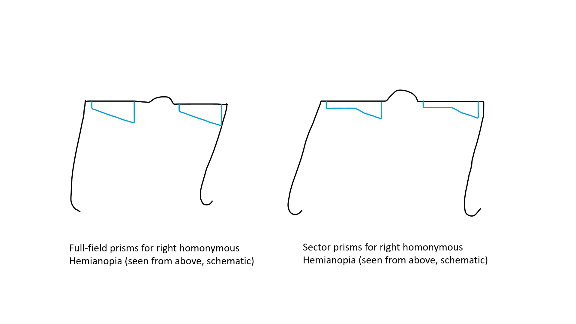 Yoked prisms (Full-field and sector) used in homonymous hemianopia (schematic)