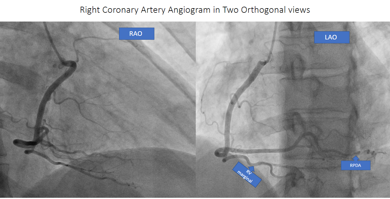 Right coronary angiogram in two orthogonal views. RAO:  right anterior oblique.  LAO: left anterior oblique.
