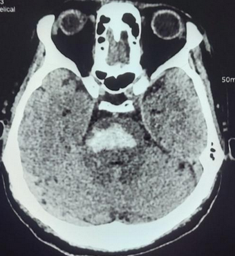 <p>Brainstem Stroke MRI. A brain MRI demonstrating a pontine hemorrhagic stroke.</p>