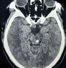 <p>Diffuse Axonal Injury III. Image of a head CT demonstrating a diffuse grade III axonal injury.</p>