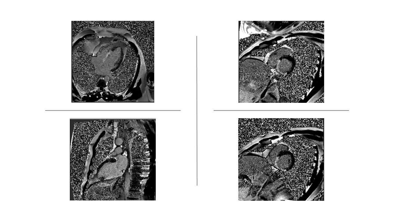 Late gadolinium enhanced (LGE) sequence of cardiac MRI.