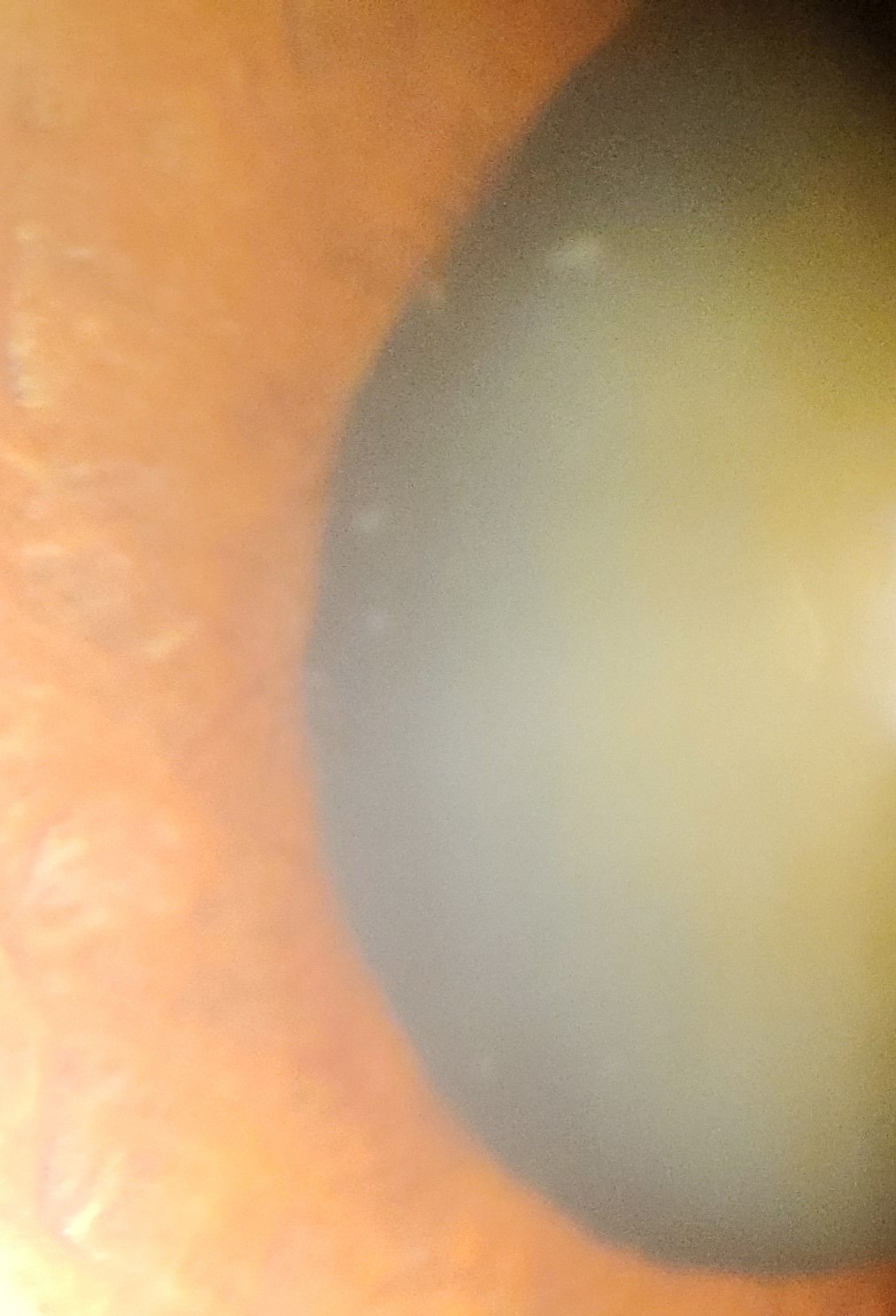 Individual with pseudoexfoliation syndrome (PEX) and cataract