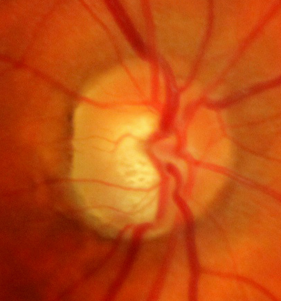 Glaucomatous optic nerve cupping in a patient with pseudoexfoliation glaucoma (PEG).