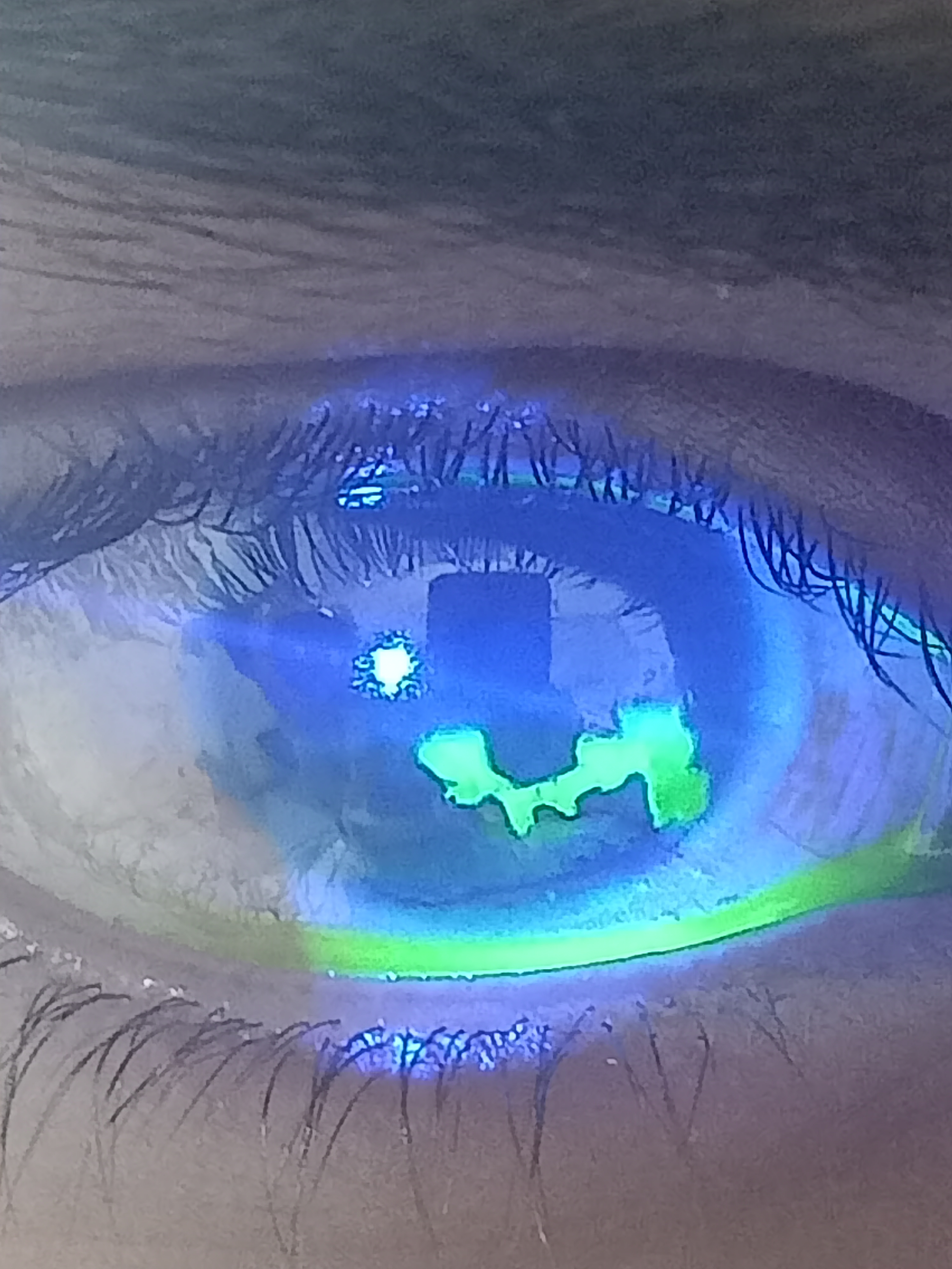 <p>Corneal Lesion. Digital image of the patient depicting a fluorescein-stained lesion.</p>