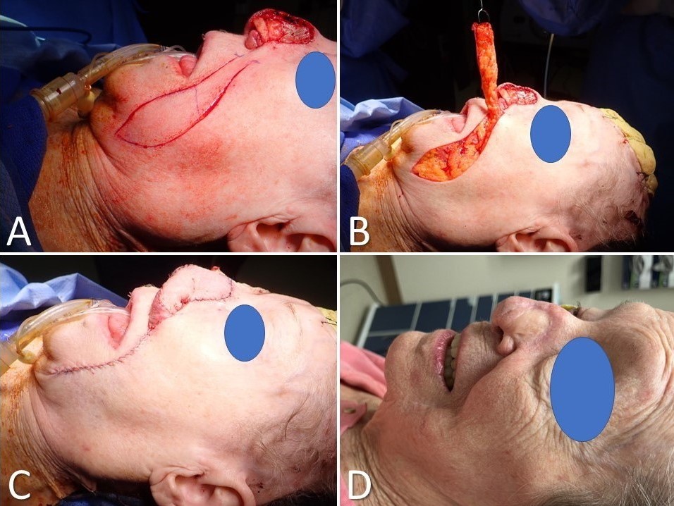 <p>Melolabial Flap for Nasal Reconstruction