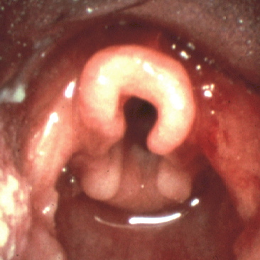 <p>Laryngoscopic View of Laryngomalacia