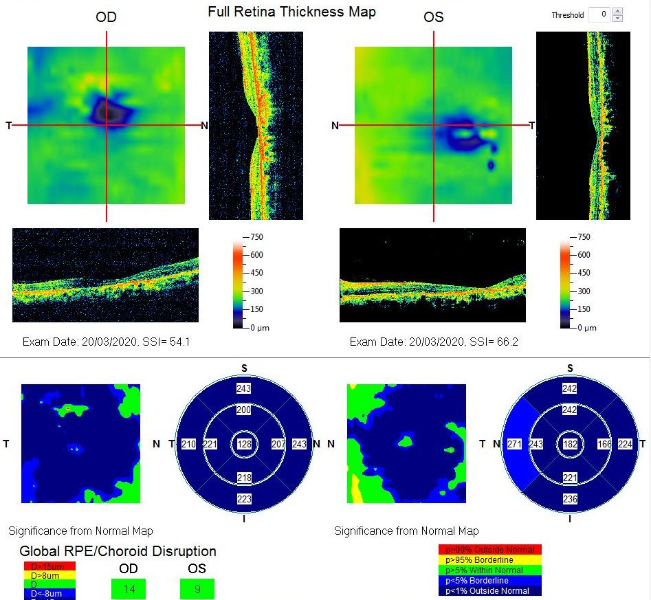 <p>Macular Thickness Map