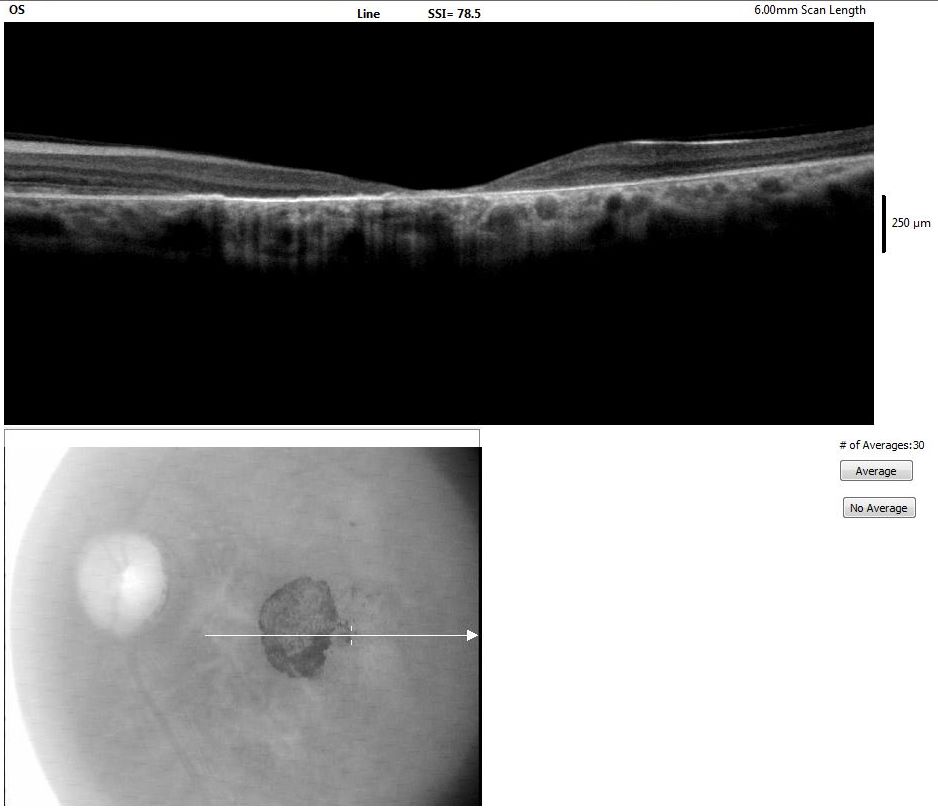 <p>Optical Coherence Tomography of the Macula