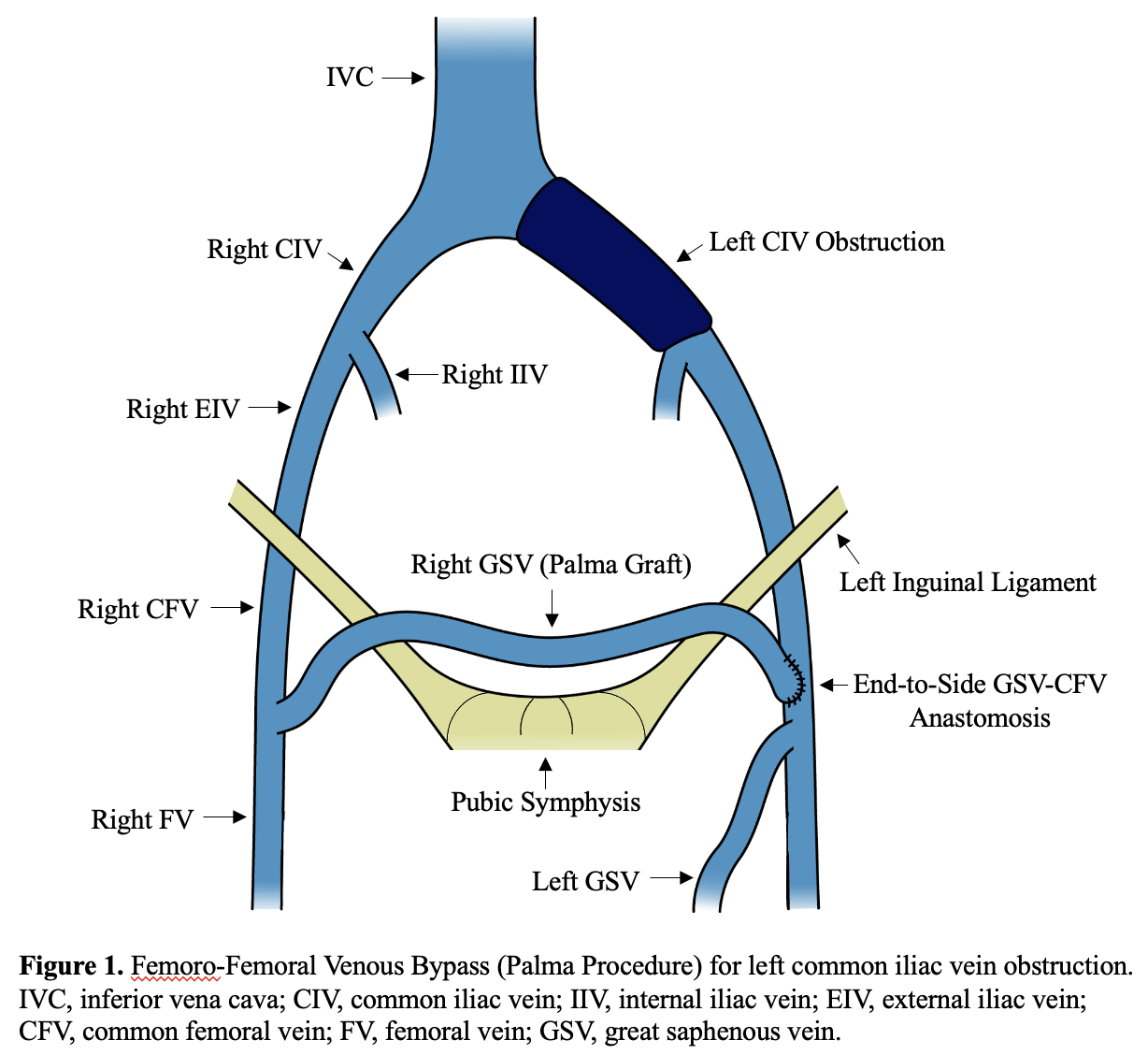 Femoro-femoral Venous Bypass. Also known as the Palma procedure.