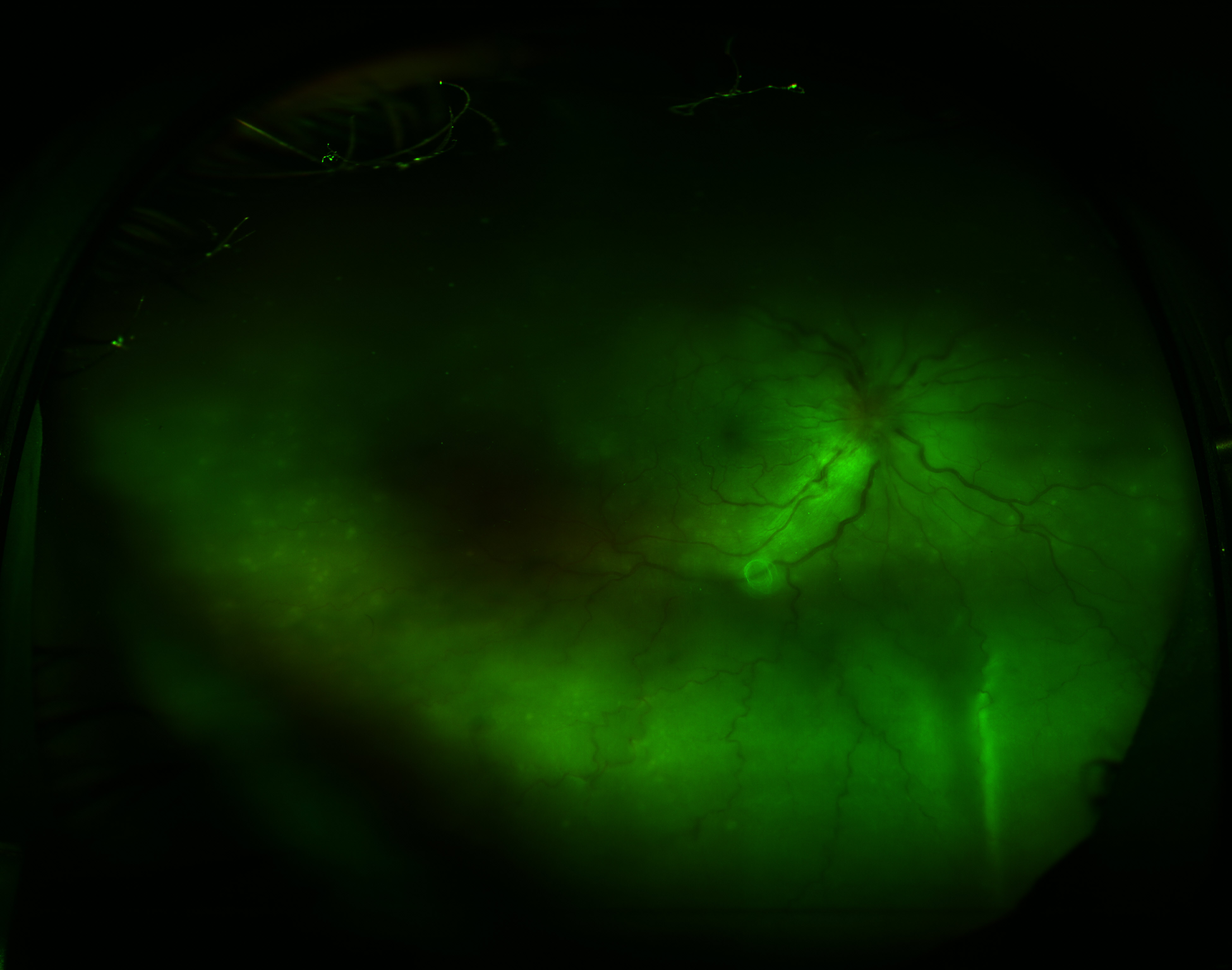 <p>Exudative Retinal Detachment in Sympathetic Ophthalmia</p>