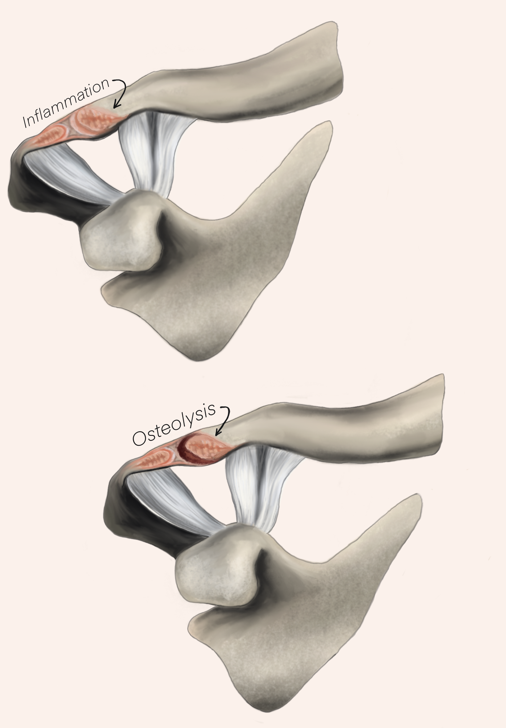 Illustration of Distal Clavicular Osteolysis