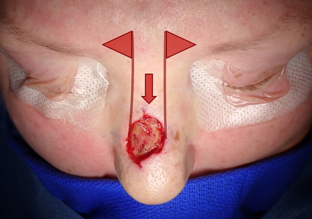 <p>Rintala Advancement Flap for Dorsal Nasal Reconstruction
