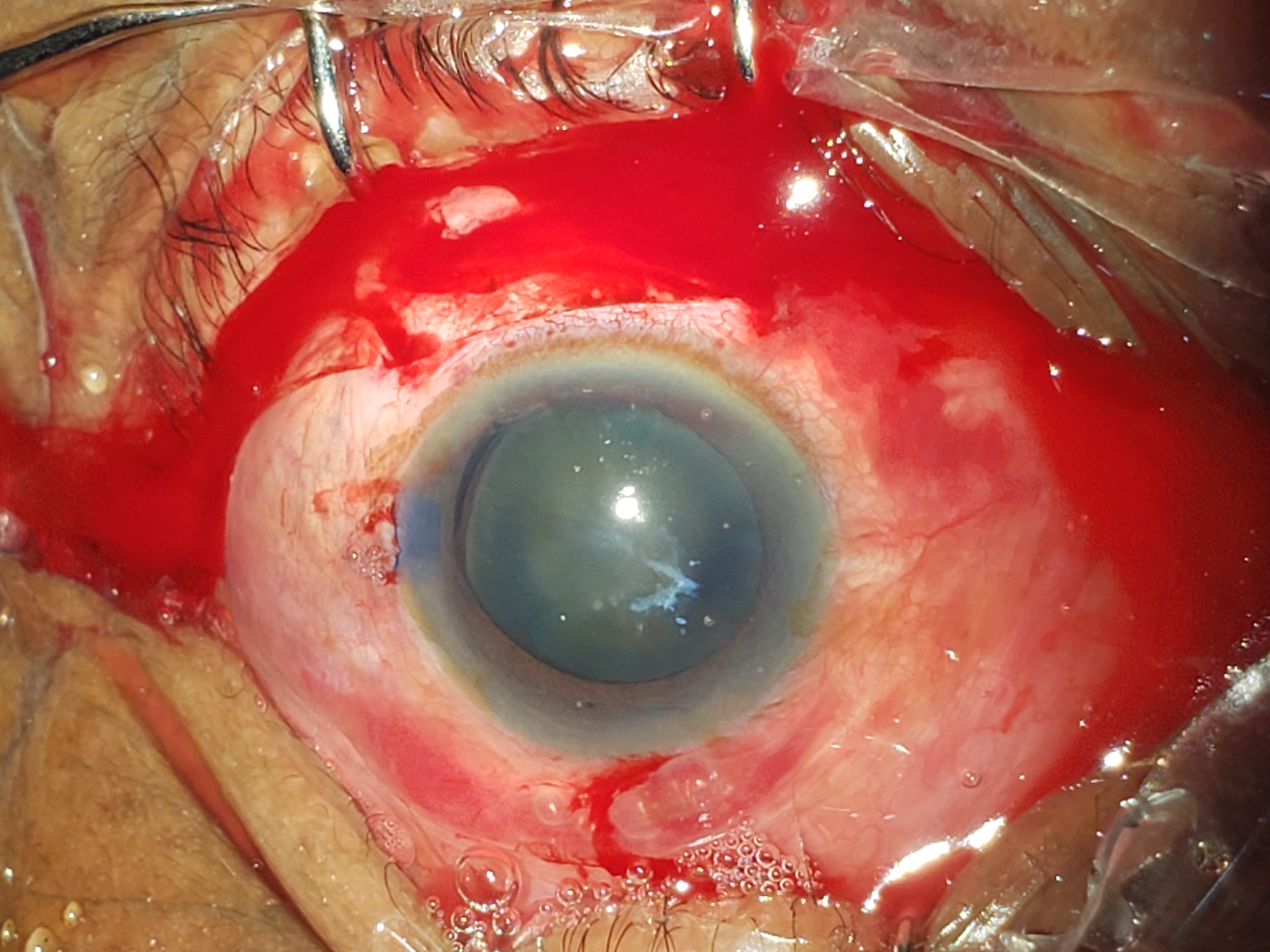 Traumatic Cataract. A traumatic cataract associated with zonular dialysis and anterior capsular fibrosis.
