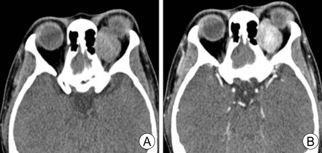 <p>Computed Tomography Image of Orbital Solitary Fibrous Tumor