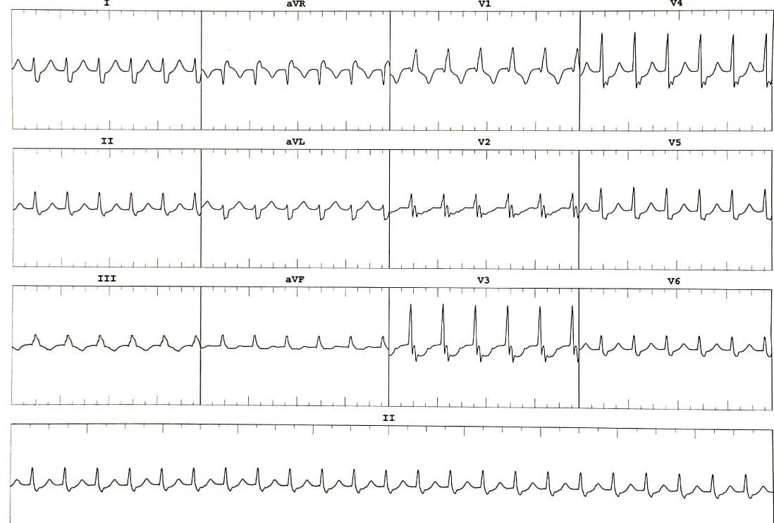 <p>Narrow Complex Tachycardia With Incomplete Right Bundle Branch