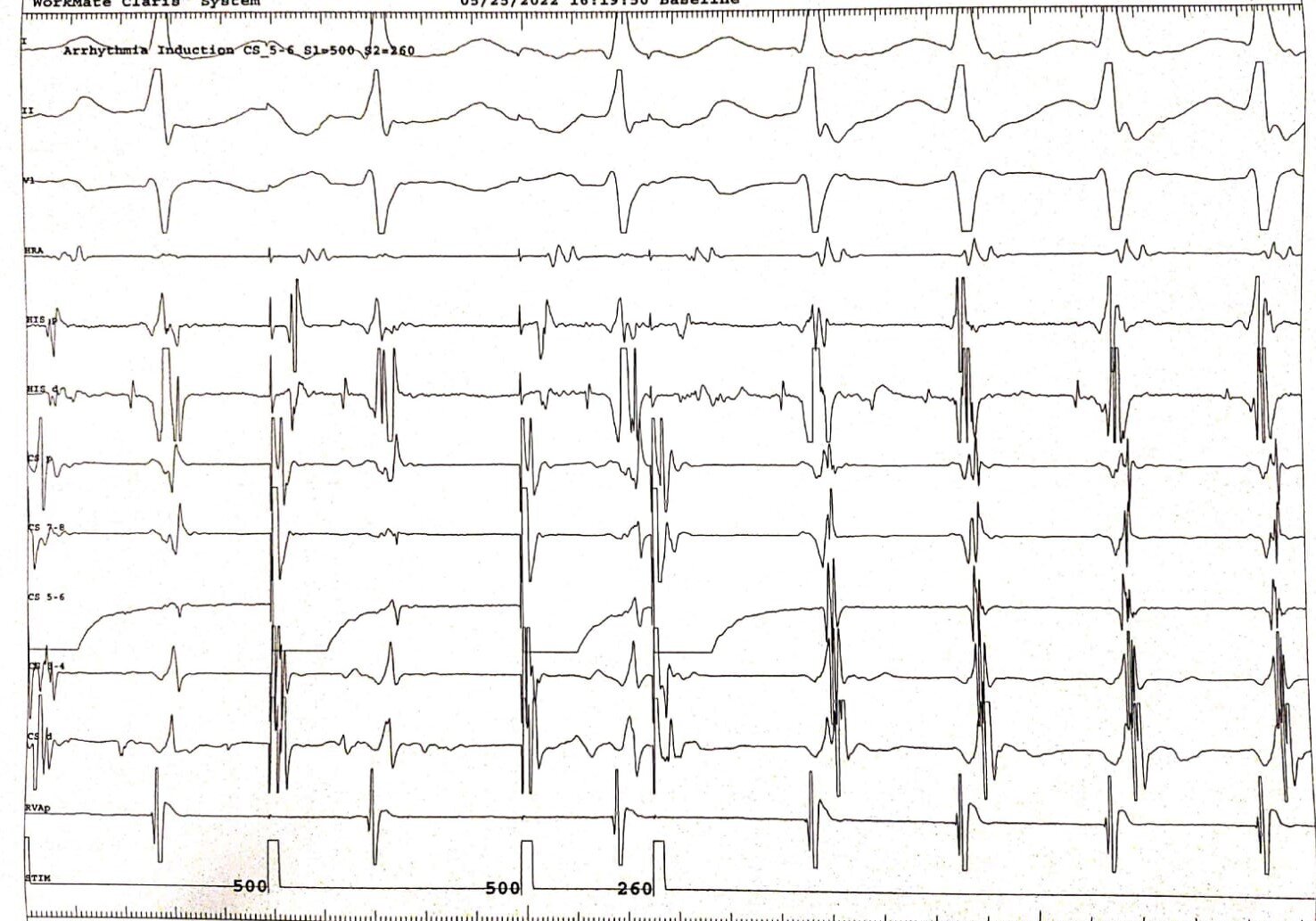 <p>Typical AVNRT Induction With Atrial Extra Stimulus