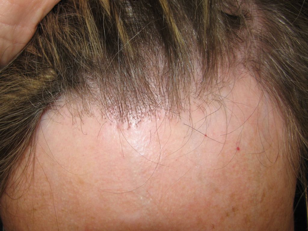 <p>Frontal Fibrosing Alopecia</p>