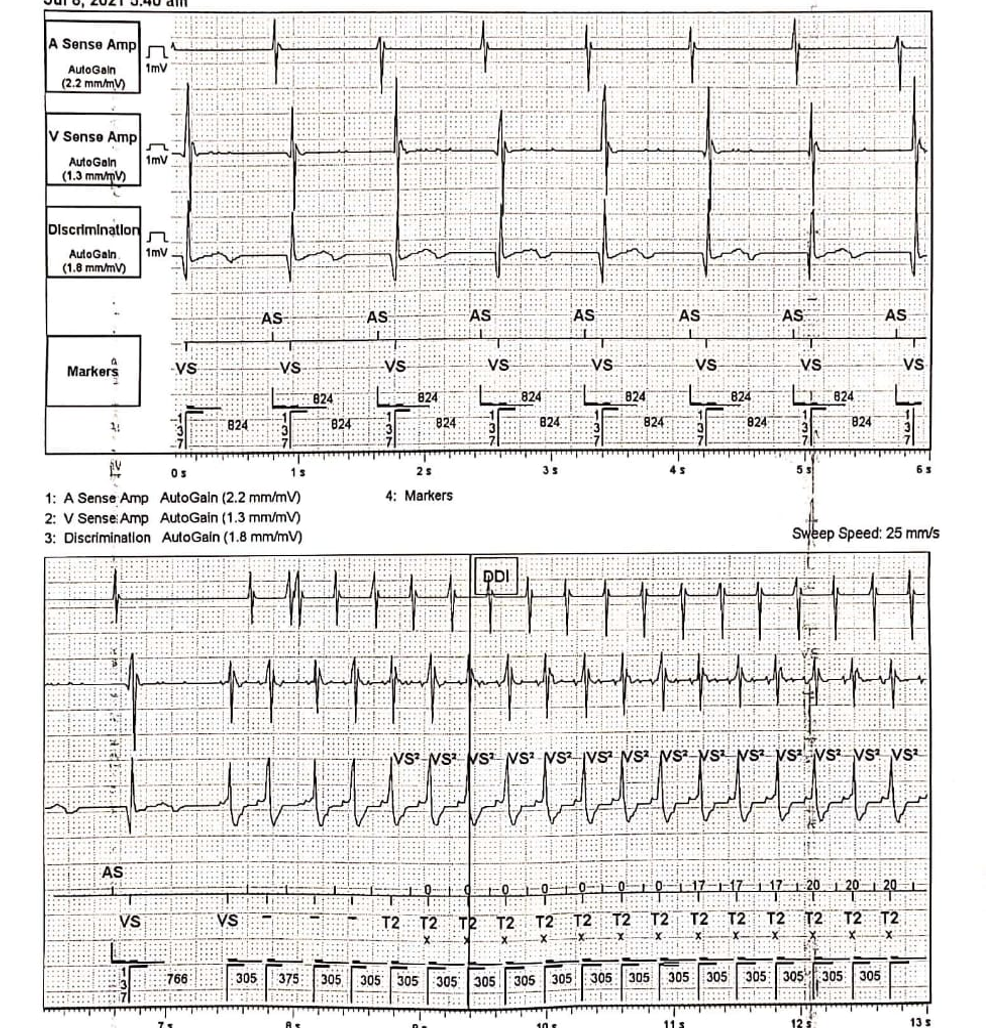 <p>Implantable Cardioverter-Defibrillator Recording