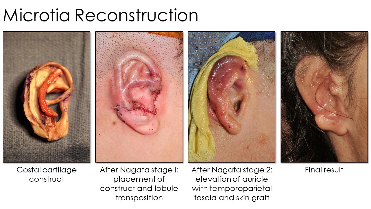 <p>Microtia Reconstruction Stages. This series of images shows the Nagata microtia reconstruction stages.</p>