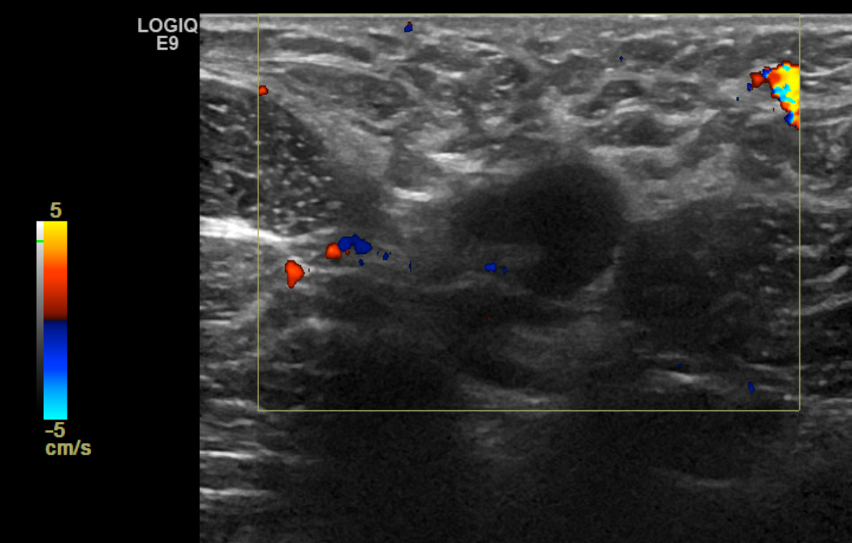 Right axillary biopsy proven malignant lymph node with cortical thickening of 6 mm.