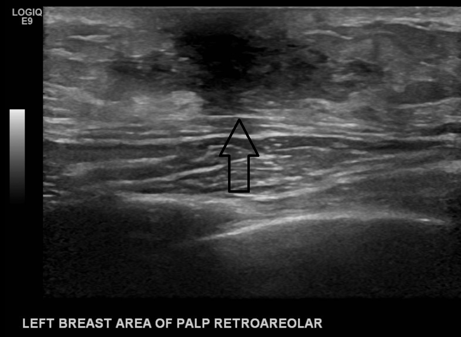 Left breast palpable abnormality in a male representative of gynecomastia