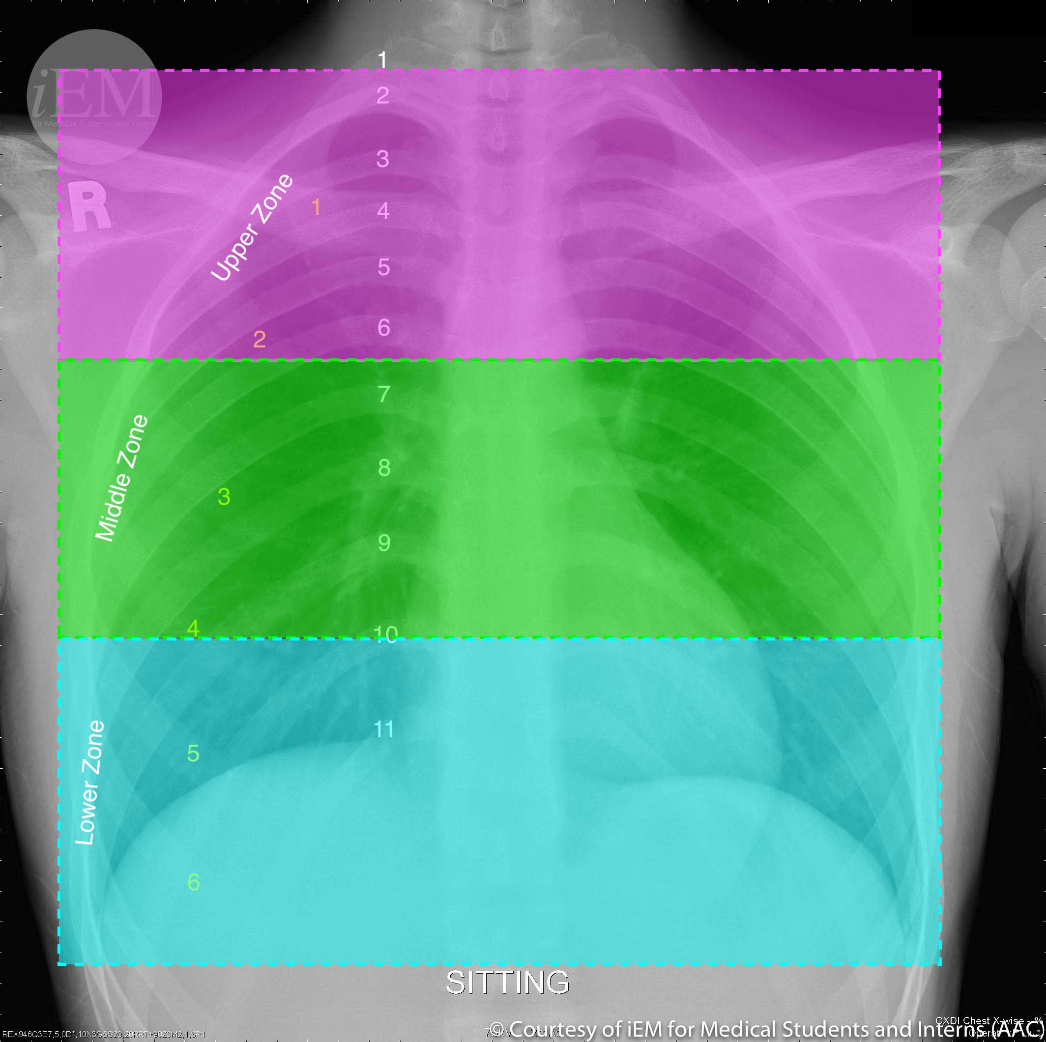 <p>Normal PA Chest X-Ray Delineated by Lung Zones