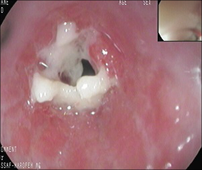 <p>Esophageal Stricture
