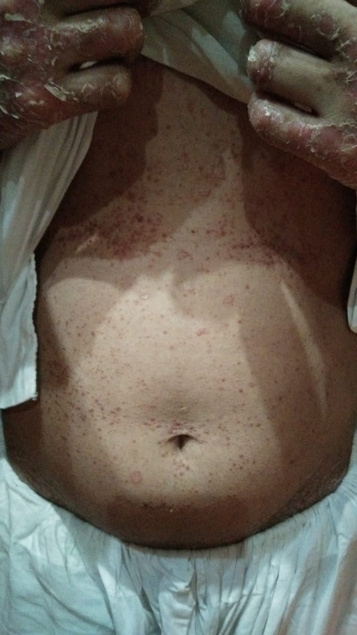 <p>Pityriasis Rubra Pilaris Lesions. Characteristic lesions of PRP on a patient's hands and abdomen.</p>