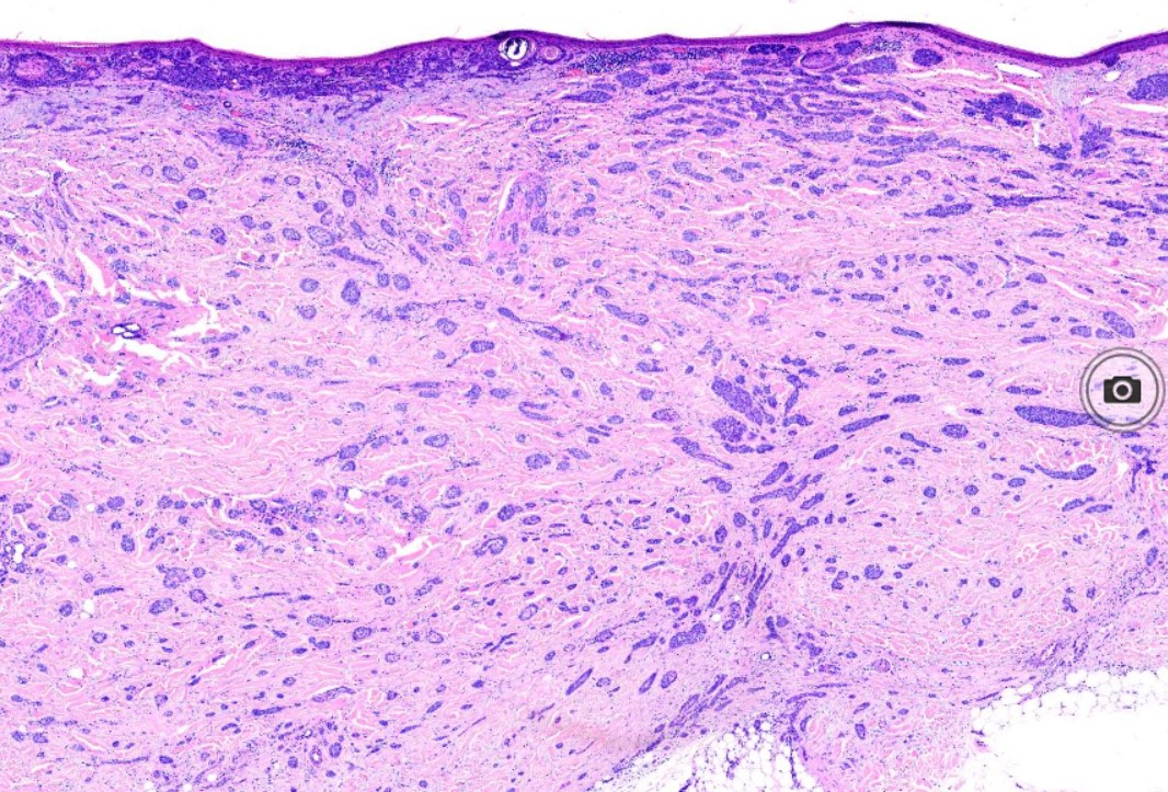 <p>Basal Cell Carcinoma With Micronodular and Morpheaform Features</p>