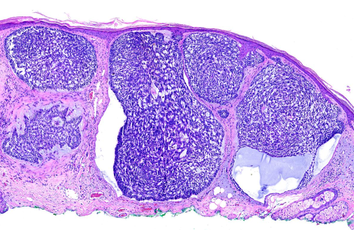 <p>Basal Cell Carcinoma, Nodular</p>