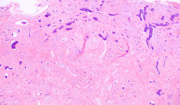 <p>Basal Cell Carcinoma, Morpheaform</p>