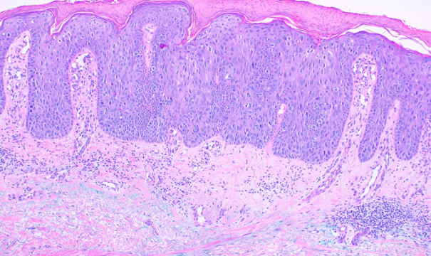 <p>Squamous Cell Carcinoma in Situ, Bowen Disease</p>