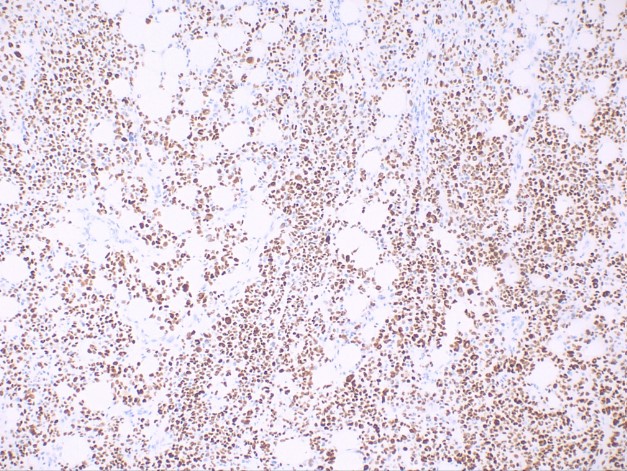 <p>Squamous Cell Carcinoma, Positive p40 Stain</p>