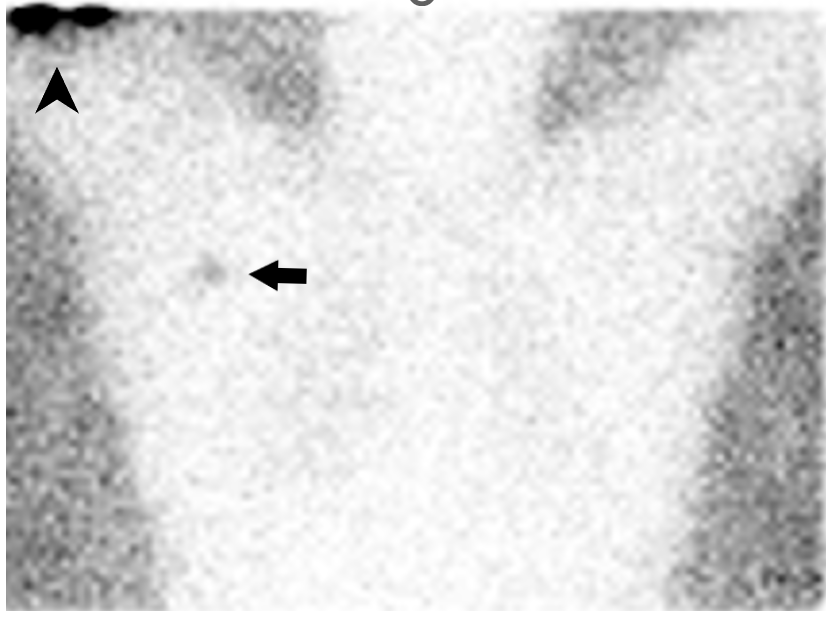 <p>Lymphoscintigraphy, Melanoma