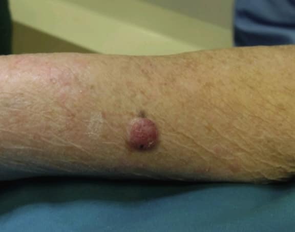 <p>Nodular Lesion of Poroma. The image shows a red, nodular lesion characteristic of a poroma in a patient.</p>
