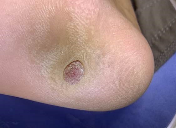 <p>Poroma on a Patient's Sole. The image shows a poroma on the sole of a patient's foot.</p>