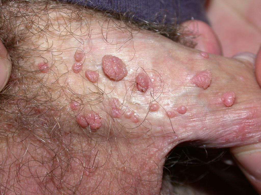 Genital Warts, Male