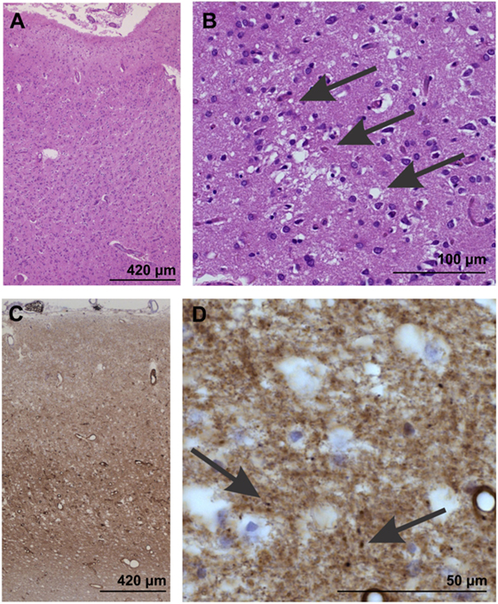 <p>Neuropathological Confirmation of Creutzfeldt-Jakob&nbsp;Disease