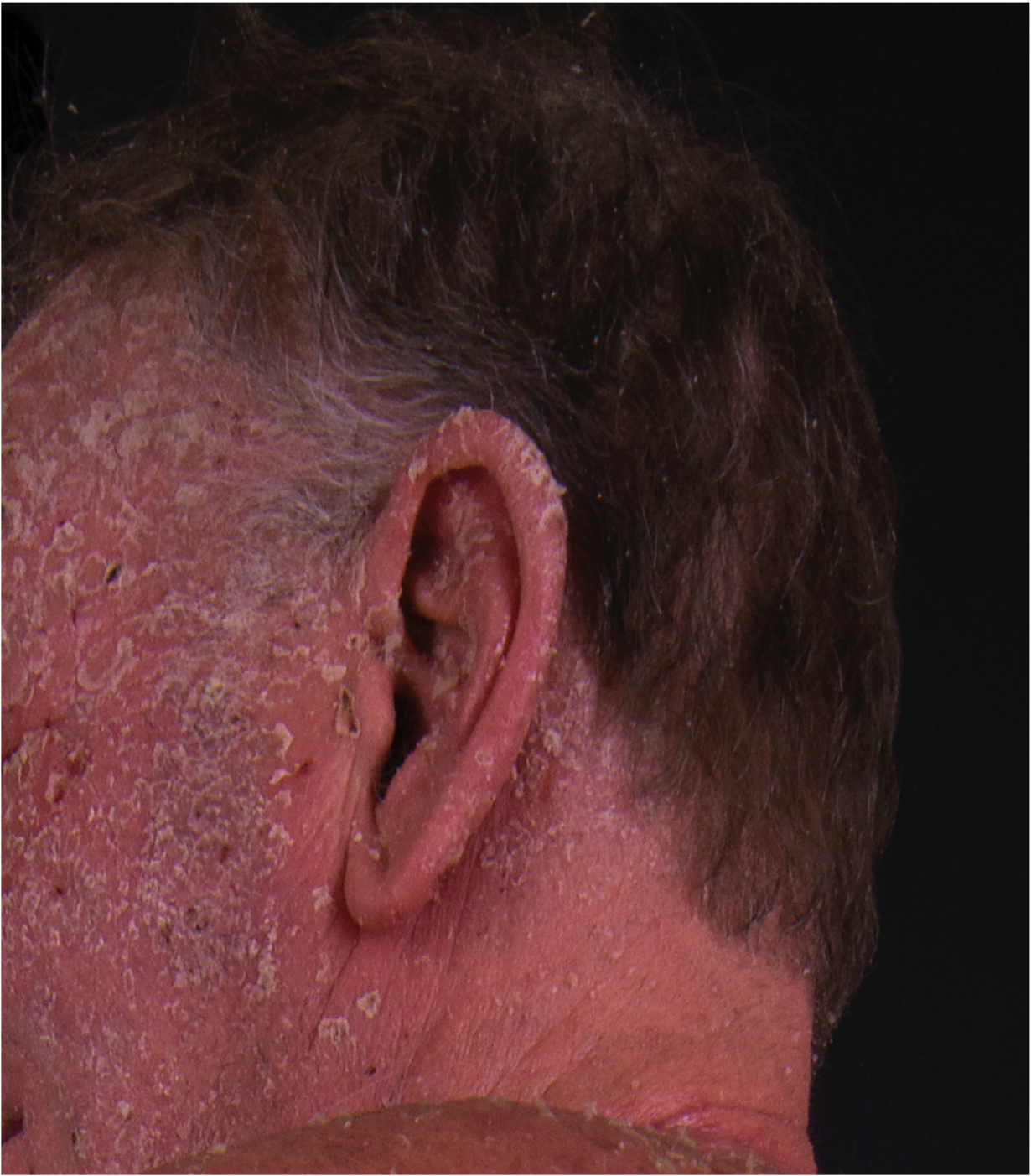 <p>Facial Pityriasis Rubra Pilaris. PRP with lateral facial involvement and thicker plate-like scale.</p>