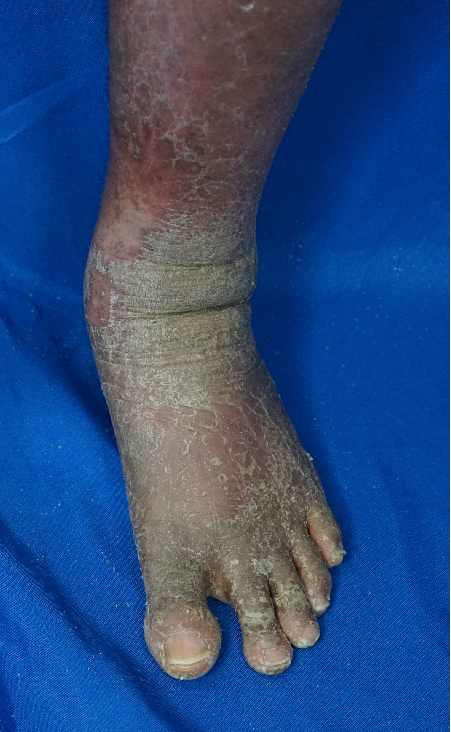<p>Pityriasis Rubra Pilaris of the Dorsal Foot