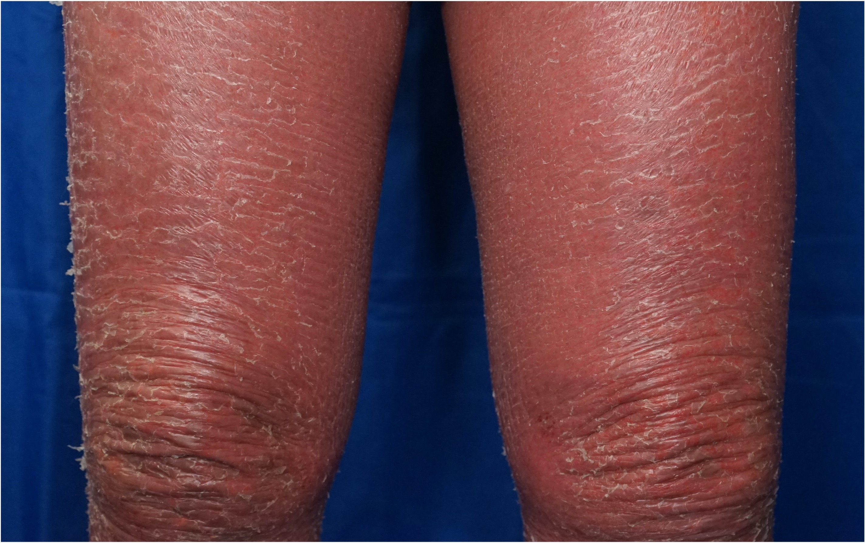 <p>Pityriasis Rubra Pilaris With Atypical Ichthyosiform Scale