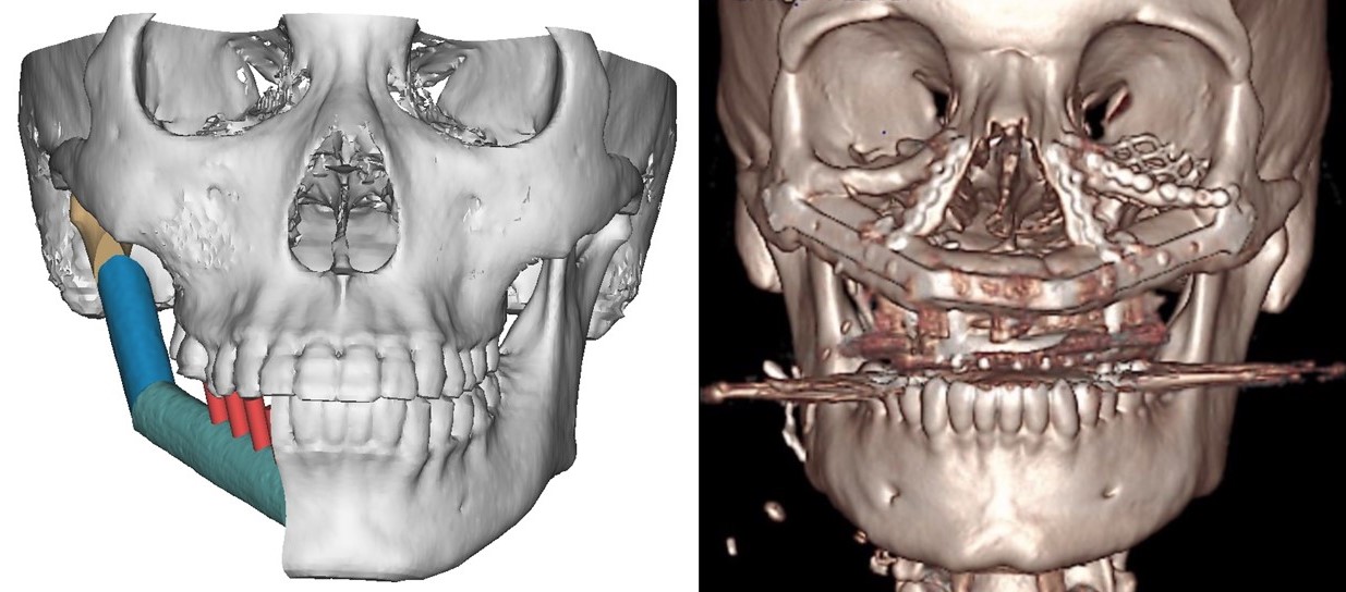 <p>Hemimandibulectomy Preoperative Planning and Reconstructed Maxilla Scan
