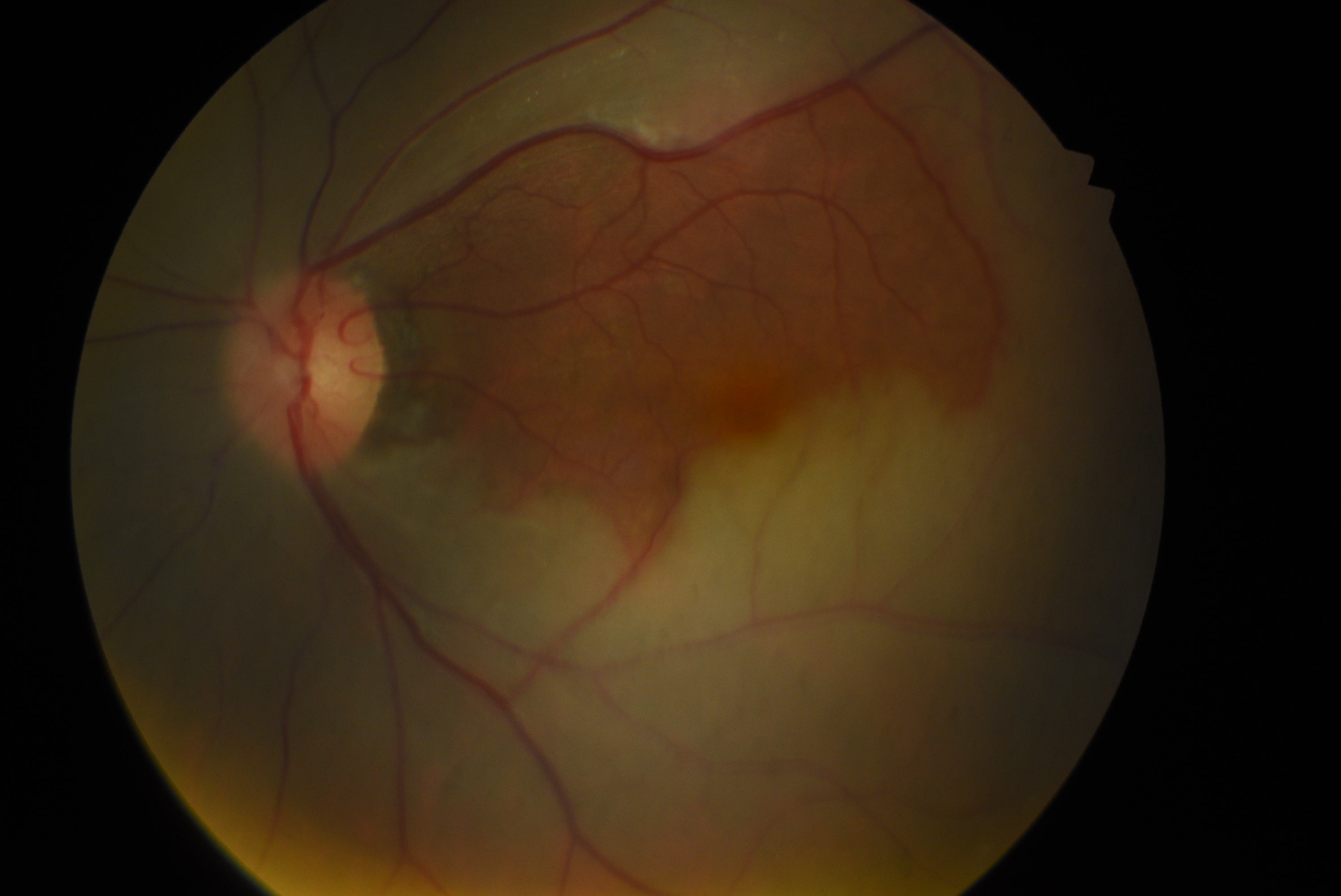 <p>Central Retinal Artery Occlusion With Cilioretinal Artery Sparing