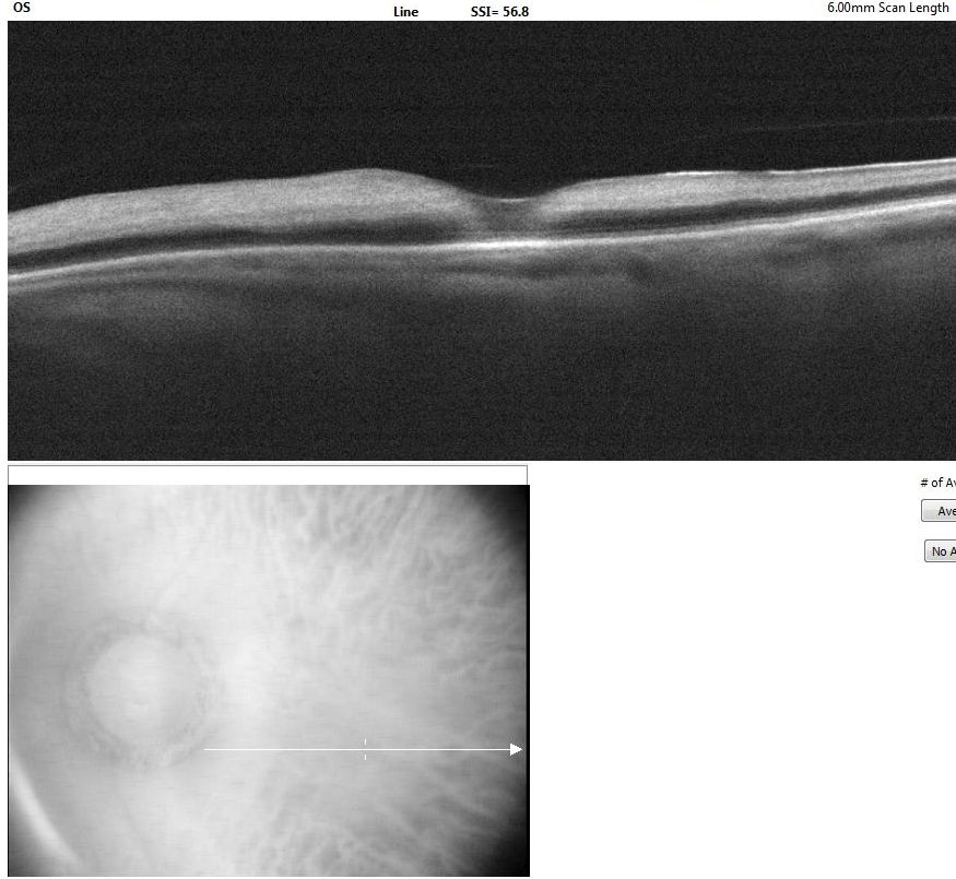 <p>Optical Coherence Tomography of Macula in Central Retinal Artery Occlusion