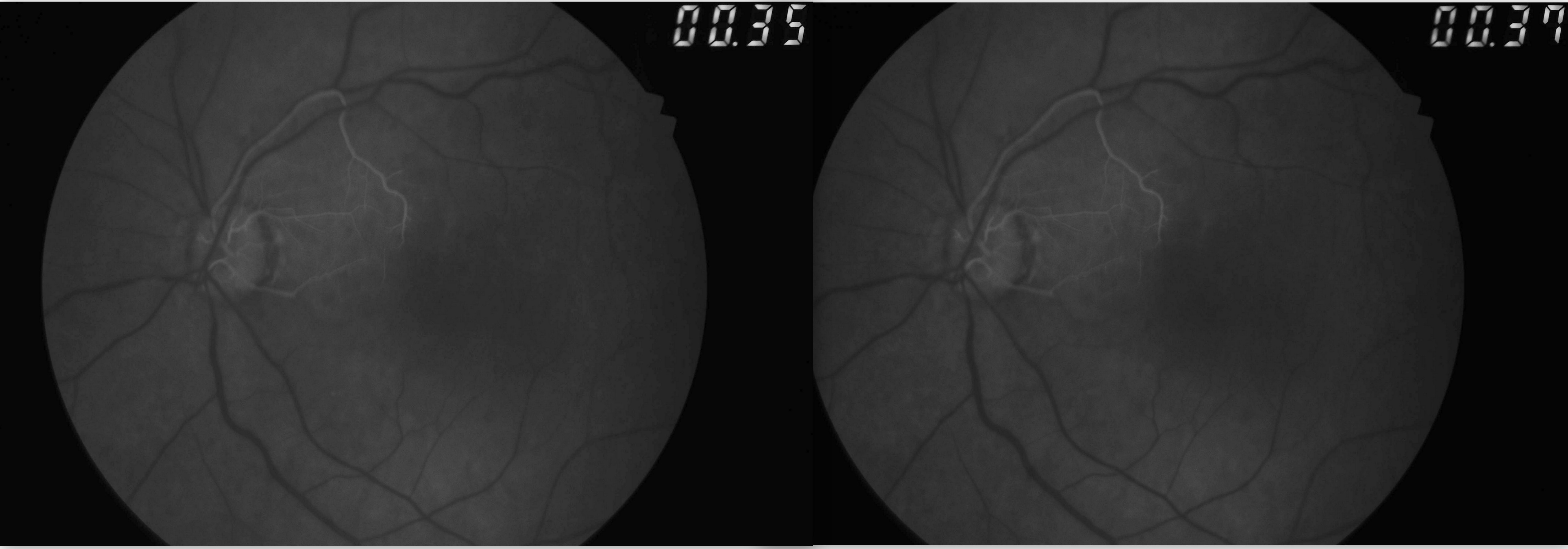 <p>Fundus Fluorescein Angiogram in Central Retinal Artery Occlusion