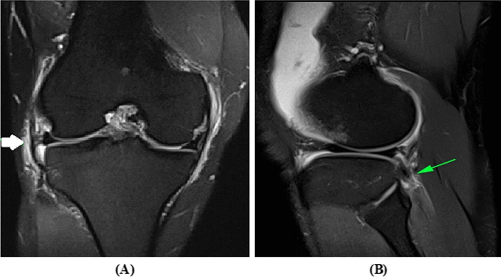 <p>Lateral Collateral Ligament and Popliteotendinous Complex Injuries on MRI