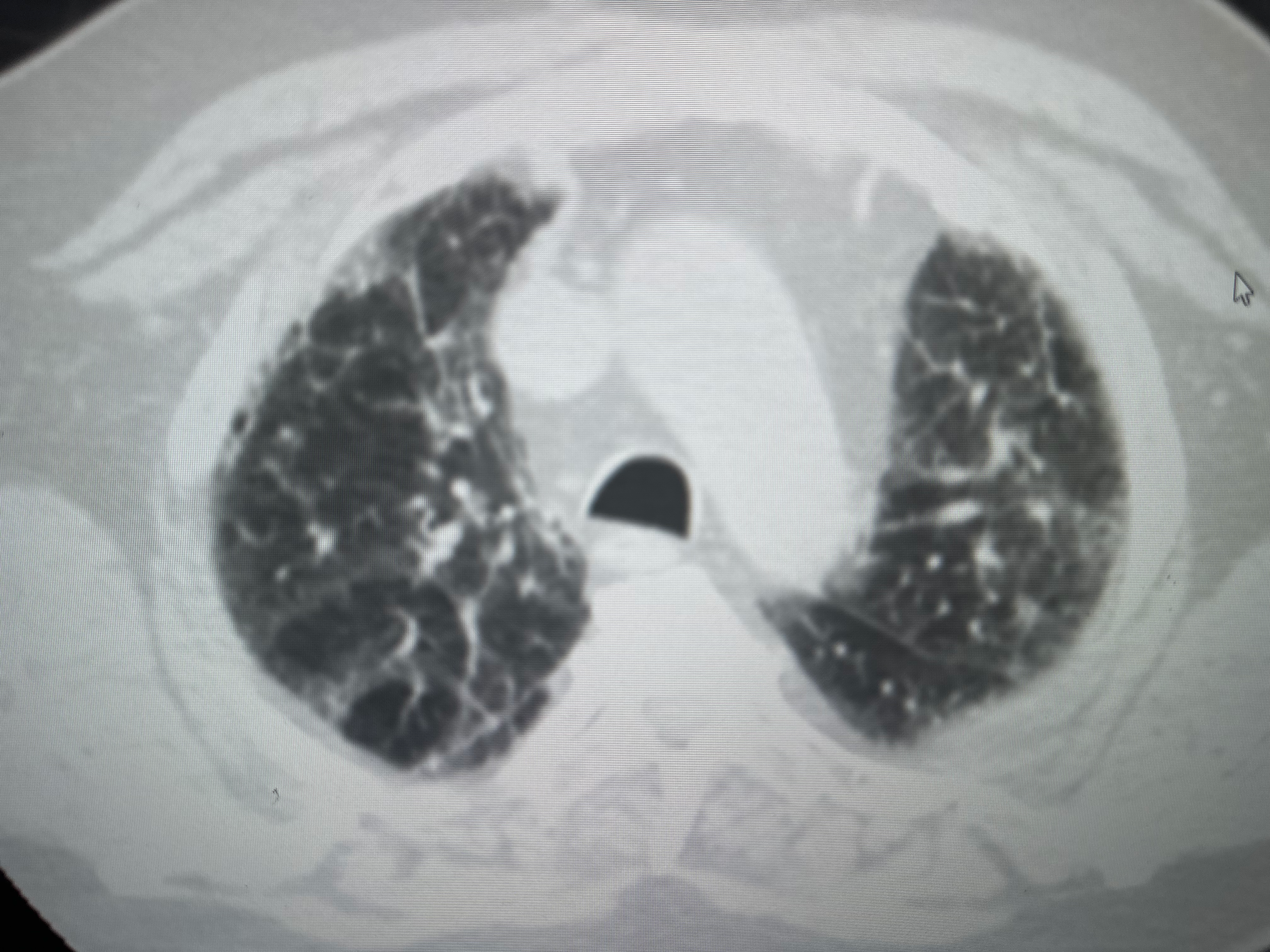 <p>Radiological Characteristics of CT Patterns for Suspected UIP